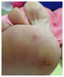 Diabetische voet ( Deze afbeelding is na de Behandeling)